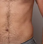 The effect of using ulike air 10 before belly hair removal