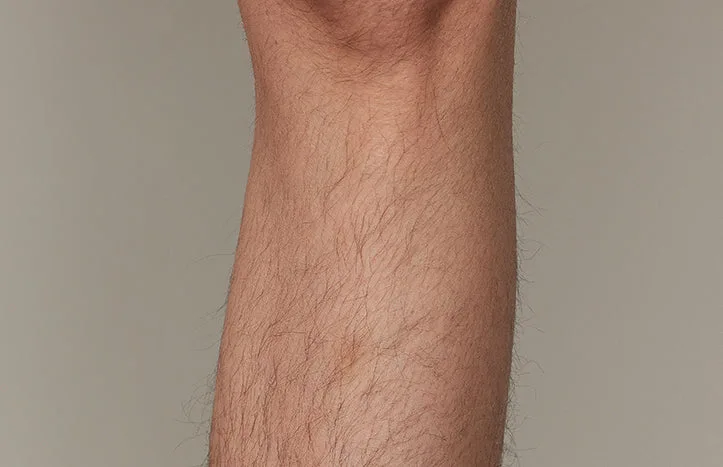 The effect of using ulike air 10 before leg hair removal